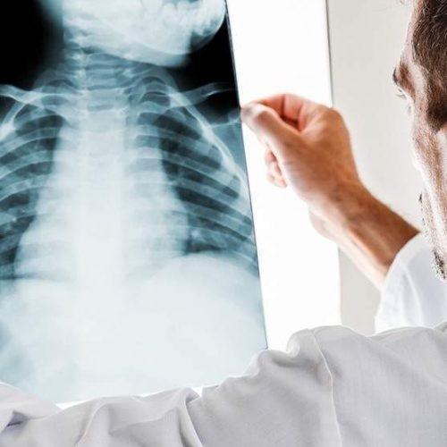 respiratoria-malaga Pulmones tratamiento fisioterapia respiratoria infantil en Málaga. Clínica FISUMA